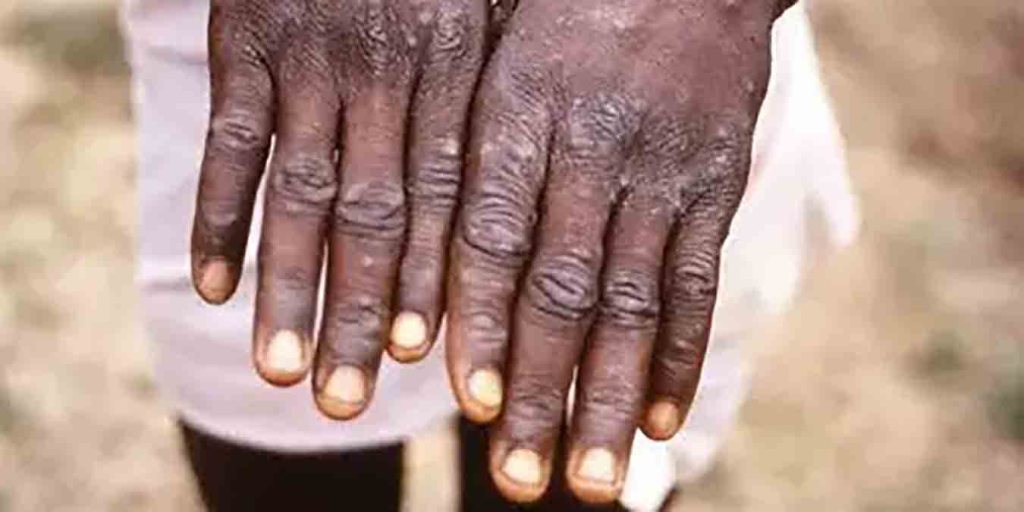 Variole du singe : Plus de 200 cas confirmés repartis sur 19 pays