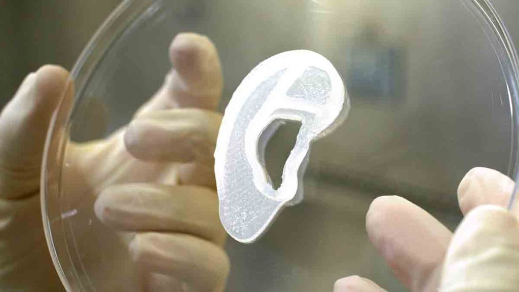Un implant d'oreille imprimé à partir de cellules humaines greffé pour la première fois
