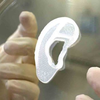 Un implant d'oreille imprimé à partir de cellules humaines greffé pour la première fois